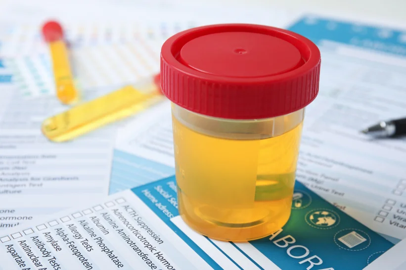 A bottle containing a urine sample for drug testing.